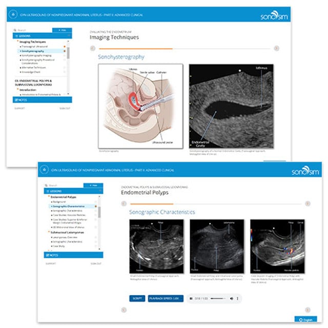 GYN Ultrasound of Nonpregnant Abnormal Uterus Advanced Clinical ...
