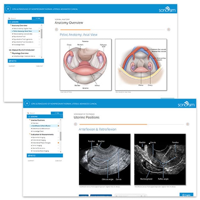 GYN Ultrasound of Nonpregnant Normal Uterus Advanced Clinical Training ...