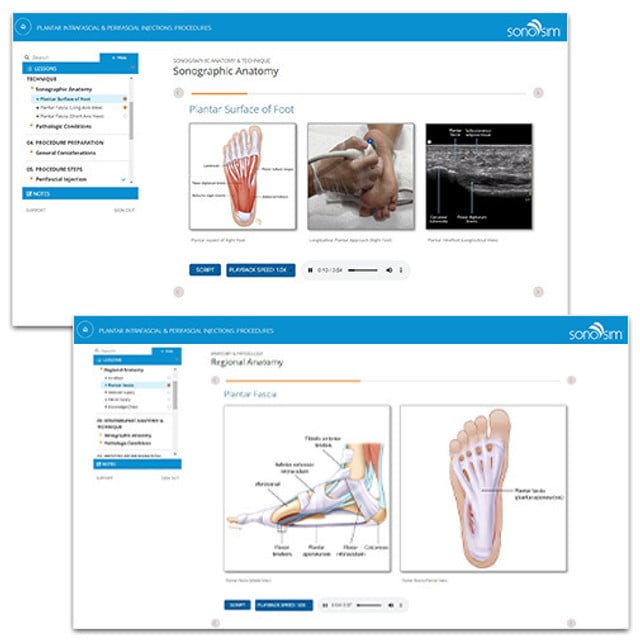 Plantar Fasciitis Ultrasound-Guided Injection Procedures | SonoSim