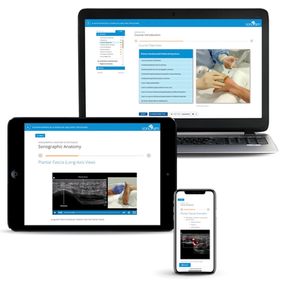 Plantar Fasciitis Ultrasound-Guided Injection Procedures | SonoSim